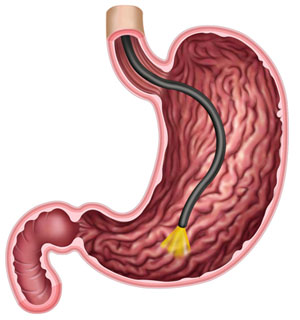 Gastroscopy