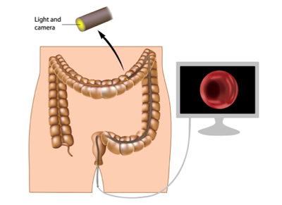 Colonoscopy